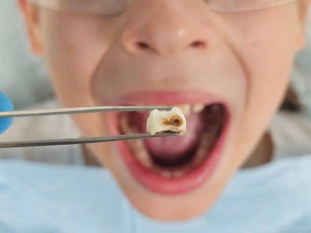 Best Emergency Broken Tooth Repair in Fort Pierce, FL